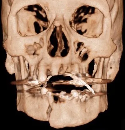 Fratura de mandíbula