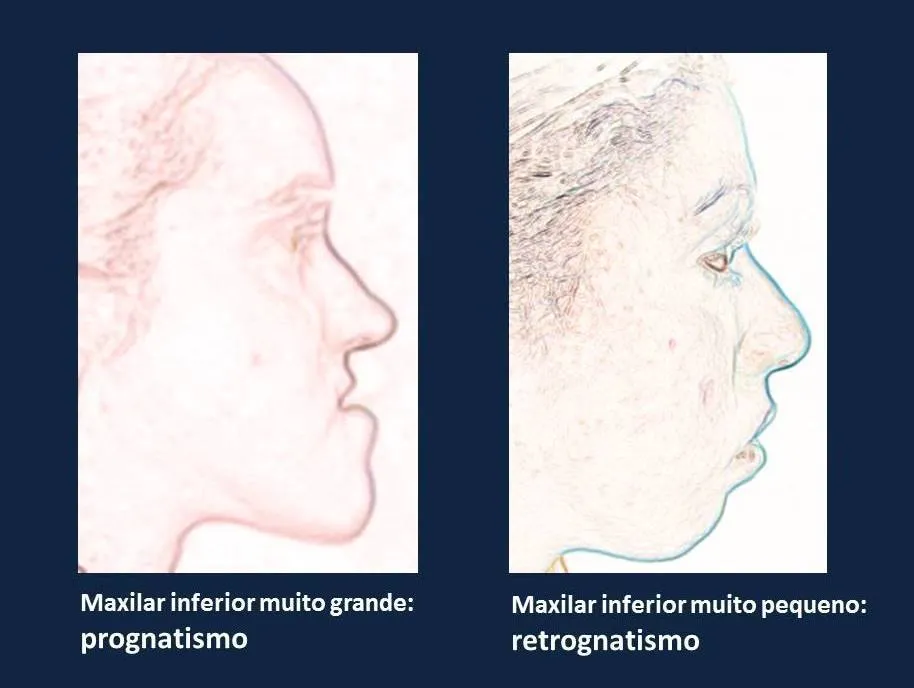 tipos ortognaticos