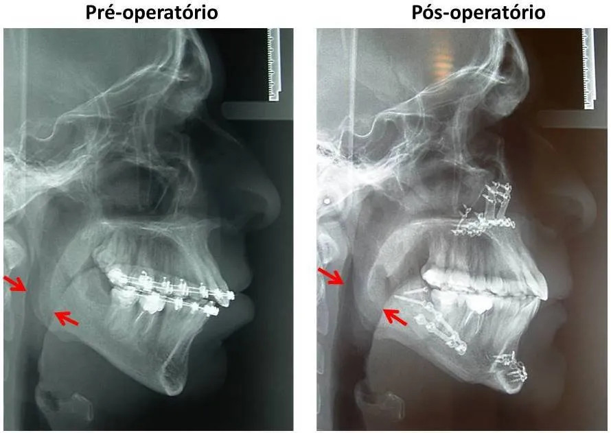 Apnéia dos sono - ortognática padrão 2